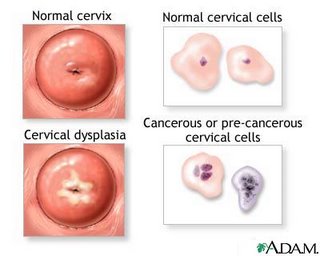 Human Papilloma Virus (HPV)