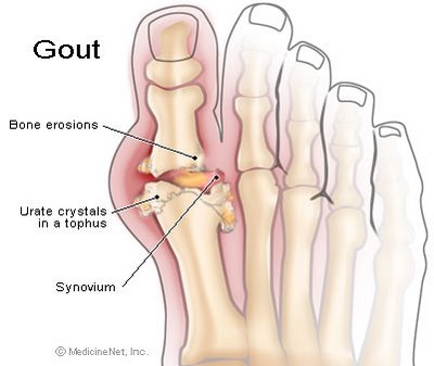 gout