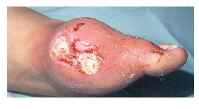 An ulcerated tophus of gout