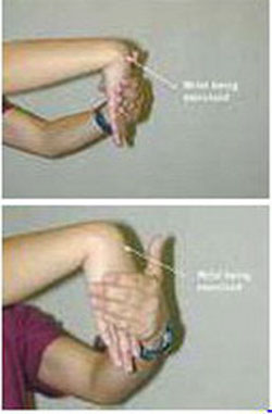 Carpal Tunnel Syndrome