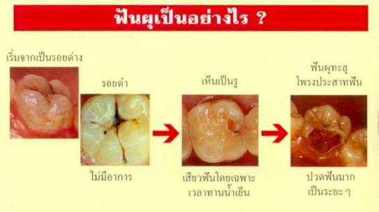 ฟันผุเป็นอย่างไร